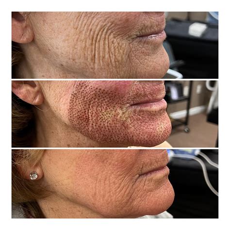 buffalo aesthetics|Fibroblast Skin Tightening in Buffalo, NY 